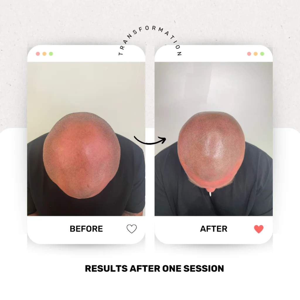 Before and after photos of Scalp Micropigmentation treatment for a man with hair loss.