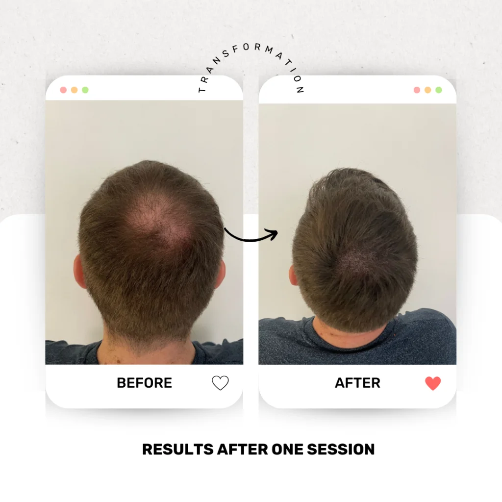 Before and after photos of Scalp Micropigmentation treatment for a man with hair loss.