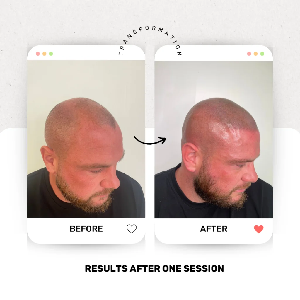 Scalp Micropigmentation in the UK