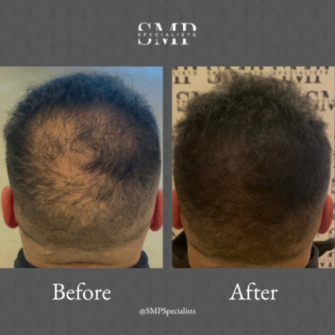 Before and after scalp micropigmentation treatment – case 1
