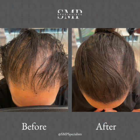 Before and after scalp micropigmentation treatment – case 10