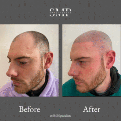 Before and after scalp micropigmentation treatment – case 11