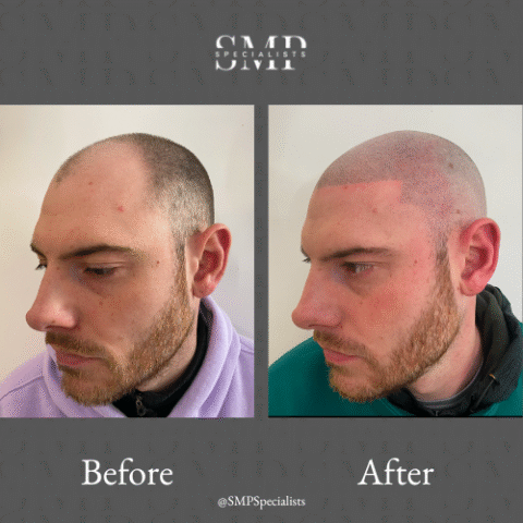Before and after scalp micropigmentation treatment – case 11