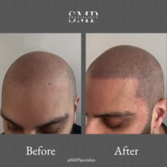 Before and after scalp micropigmentation treatment – case 13