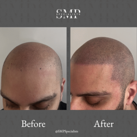 Before and after scalp micropigmentation treatment – case 13