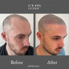 Before and after scalp micropigmentation treatment – case 14