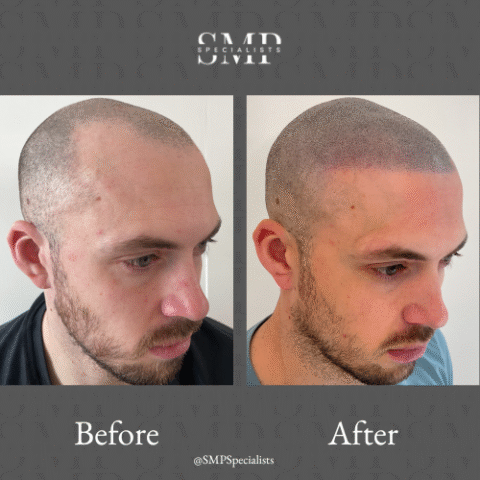 Before and after scalp micropigmentation treatment – case 14