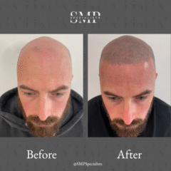 Before and after scalp micropigmentation treatment – case 15