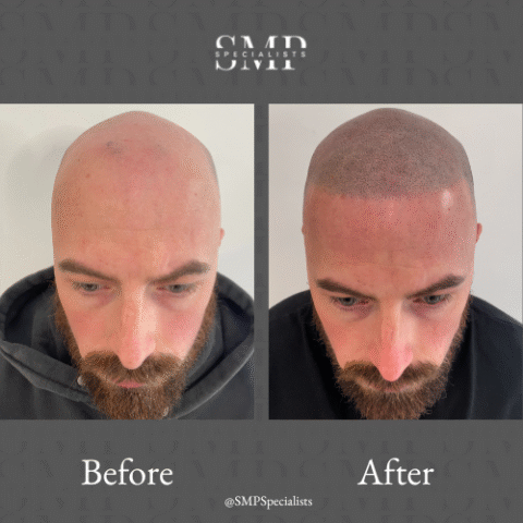 Before and after scalp micropigmentation treatment – case 15