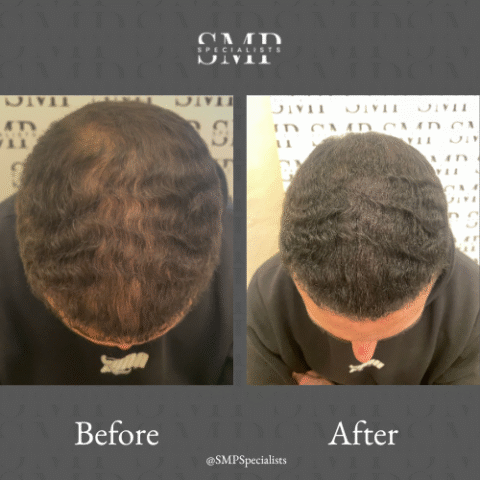 Before and after scalp micropigmentation treatment – case 16