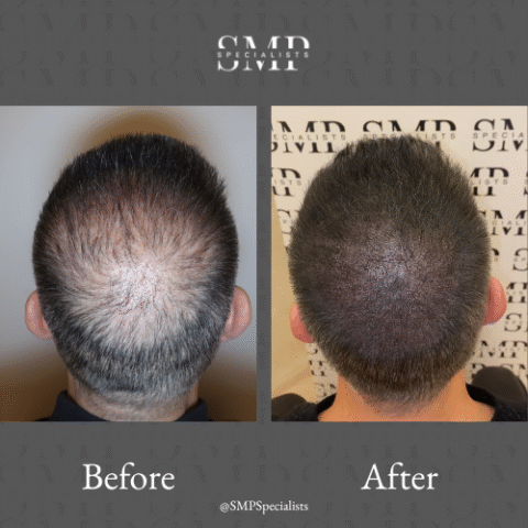 Before and after scalp micropigmentation treatment – case 17