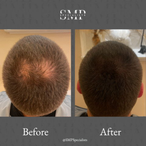 Before and after scalp micropigmentation treatment – case 18