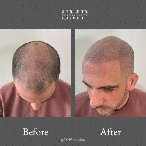 Before and after scalp micropigmentation treatment – case 2