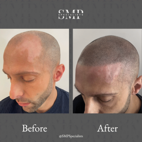 Before and after scalp micropigmentation treatment – case 20