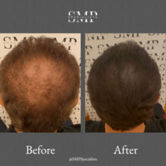 Before and after scalp micropigmentation treatment – case 22