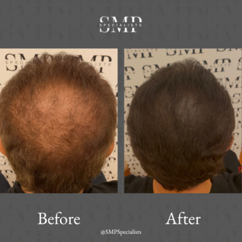 Before and after scalp micropigmentation treatment – case 22