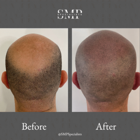 Before and after scalp micropigmentation treatment – case 23