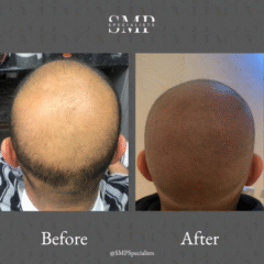 Before and after scalp micropigmentation treatment – case 24