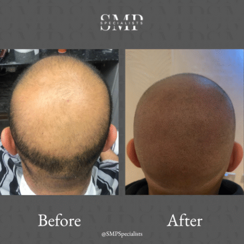 Before and after scalp micropigmentation treatment – case 24