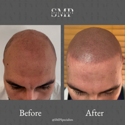 Before and after scalp micropigmentation treatment – case 4