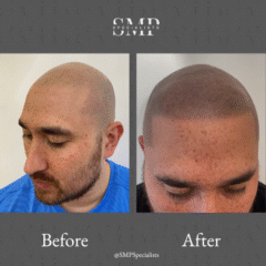 Before and after scalp micropigmentation treatment – case 6