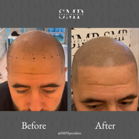 Before and after scalp micropigmentation treatment – case 7