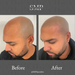 Before and after scalp micropigmentation treatment – case 8