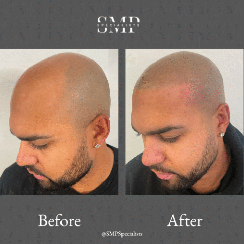 Before and after scalp micropigmentation treatment – case 8