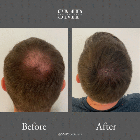 Before and after scalp micropigmentation treatment – case 9